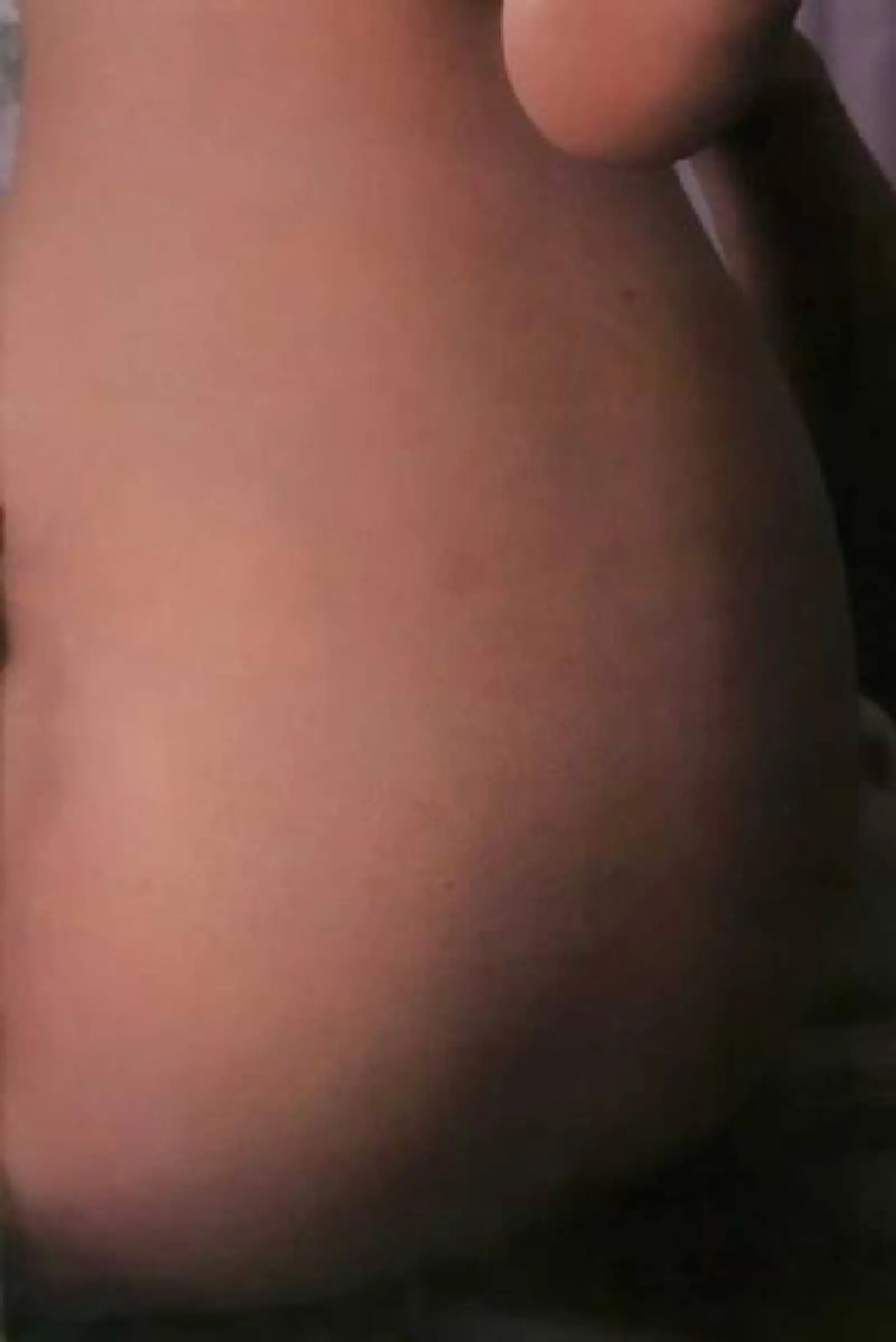 肉ひだ痉挛（1981-01-01）